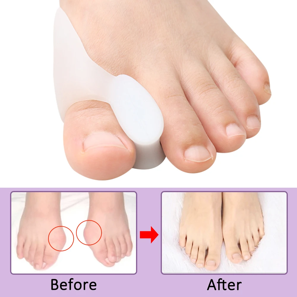 2/4/8Pcs Spacer Gel Big Bunion - Toe Separator Silicon avaliação e preço